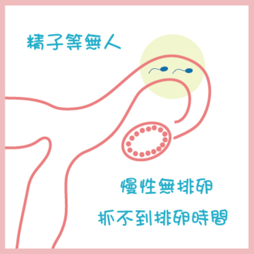 多囊性卵巢症候群PCOS：Polycystic Ovaries Syndrome產品圖