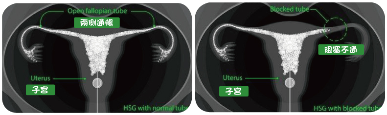 子宮輸卵管攝影 