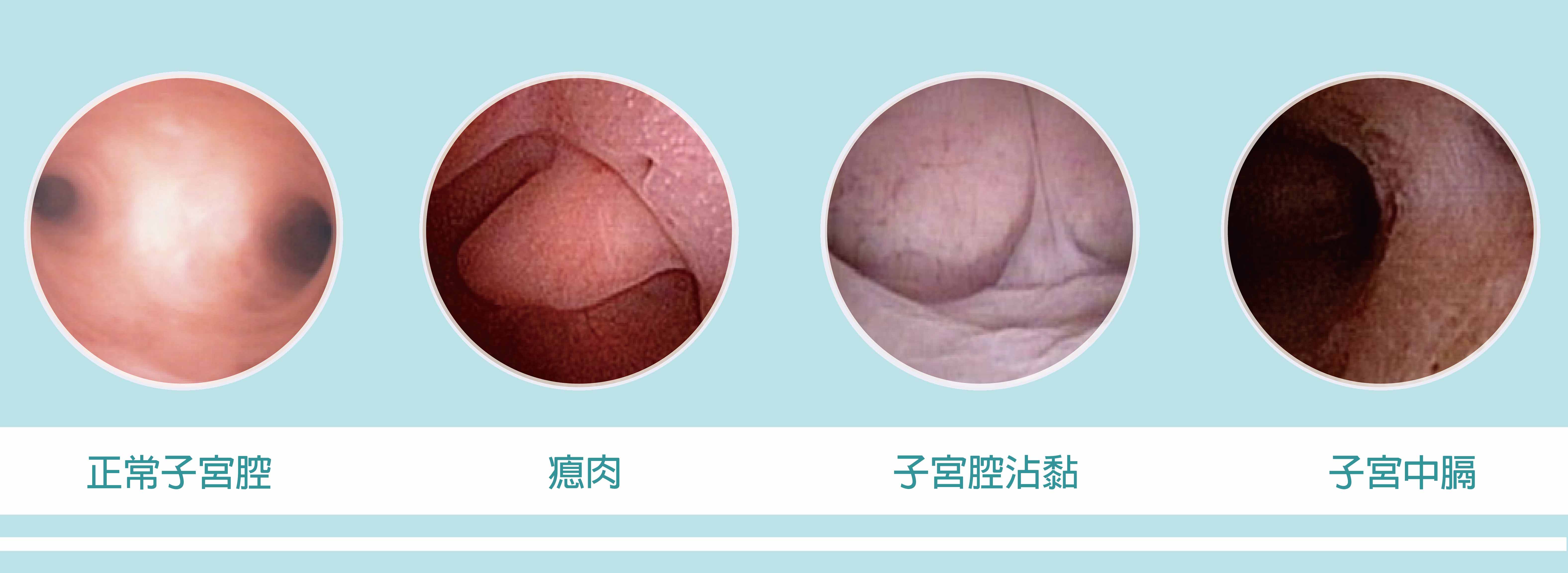 子宮內視鏡檢查 Hysteroscopy 想知道更多 不孕症治療與檢查 服務項目 試管嬰兒 不孕症治療2022好孕連連專案起跑 樂芙生殖醫學中心台中文心路捷運綠線步行5分鐘